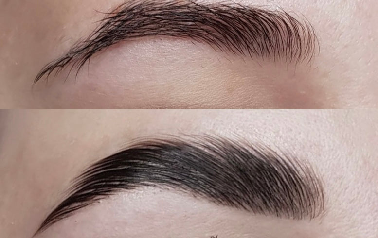 (115) Brow-lifting / Browlift