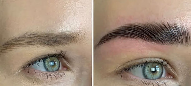 (115) Brow-lifting / Browlift