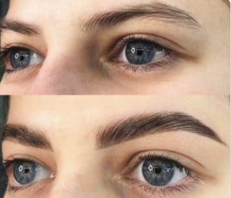 (115) Brow-lifting / Browlift